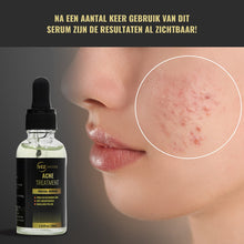 SEZGoods Acne Serum - Skincare - Acne Behandeling - Puisten Verwijderaar - Pigmentvlekken Verwijderen