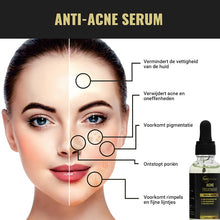 SEZGoods Acne Serum - Skincare - Acne Behandeling - Puisten Verwijderaar - Pigmentvlekken Verwijderen